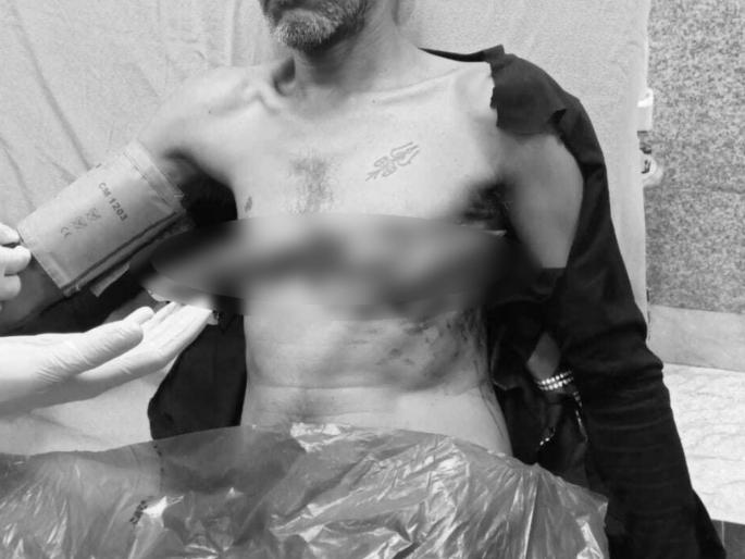 The injured patient reached the hospital with a 10 inch long knife in his chest in Bhopal | थरारक! छातीत १० इंच लांबीचा चाकू घुसलेल्या अवस्थेत जखमी रुग्ण हॉस्पिटलमध्ये पोहचला, मग... The injured patient reached the hospital with a 10 inch long knife in his chest in Bhopal | थरारक! छातीत १० इंच लांबीचा चाकू घुसलेल्या अवस्थेत जखमी रुग्ण हॉस्पिटलमध्ये पोहचला, मग...