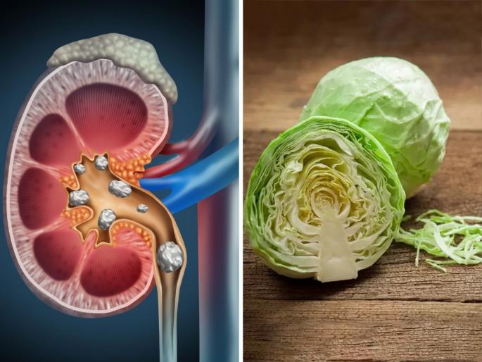 Superfoods for kidney : Which foods clean and repair kidney | किडनीचे फिल्टर खराब झाले की रक्त होतं विषारी, या उपायांनी ठेवा सुरक्षित! Superfoods for kidney : Which foods clean and repair kidney | किडनीचे फिल्टर खराब झाले की रक्त होतं विषारी, या उपायांनी ठेवा सुरक्षित!