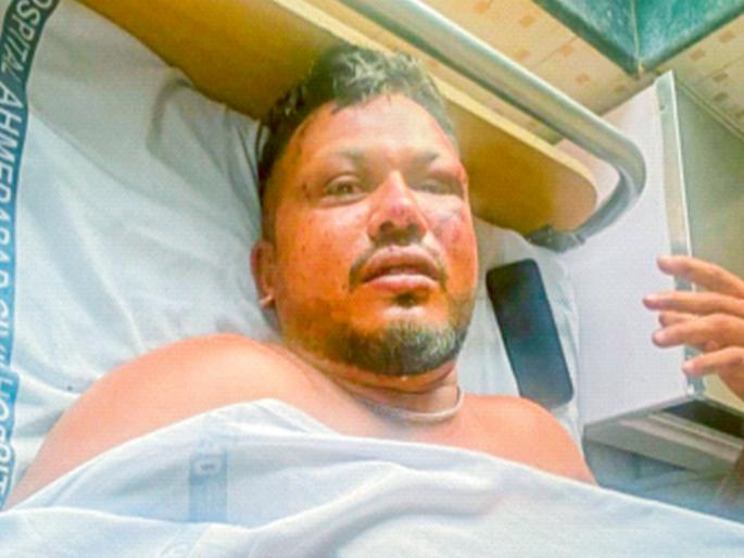 Air India Plane Crash: "People could still have survived, but...", claims sole survivor of plane crash | "अजूनही लोक वाचू शकले असते, परंतु...", विमान अपघातात वाचलेल्या एकमेव प्रवाशाने केला दावा Air India Plane Crash: "People could still have survived, but...", claims sole survivor of plane crash | "अजूनही लोक वाचू शकले असते, परंतु...", विमान अपघातात वाचलेल्या एकमेव प्रवाशाने केला दावा