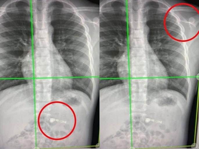 Shocking! 7 years boy swallows Airpod he received as Christmas gift in America | धक्कादायक! ७ वर्षाच्या मुलाला गिफ्ट मिळाले होते Airpods त्याने ते गिळले आणि..... Shocking! 7 years boy swallows Airpod he received as Christmas gift in America | धक्कादायक! ७ वर्षाच्या मुलाला गिफ्ट मिळाले होते Airpods त्याने ते गिळले आणि.....