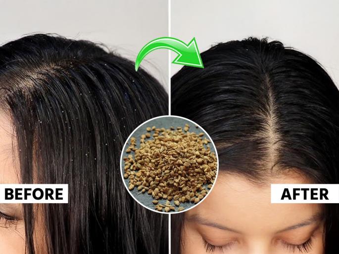 Benefits of Carom Seeds To Reduc Hair Dandruff How To Use Carom Seeds For Dandruff Control How to Use Carom Seeds for Hair Care | केसांत कोंडा, उपाय ओवा! म्हणाल, इतके दिवस इतका सोपा उपाय का नाही समजला...