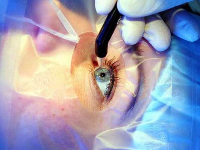 Eye surgery stalled, darkness in front of more than 600 seniors | डोळ्यांच्या शस्त्रक्रिया ठप्प, ६०० पेक्षा जास्त ज्येष्ठांसमोर अंधार Eye surgery stalled, darkness in front of more than 600 seniors | डोळ्यांच्या शस्त्रक्रिया ठप्प, ६०० पेक्षा जास्त ज्येष्ठांसमोर अंधार