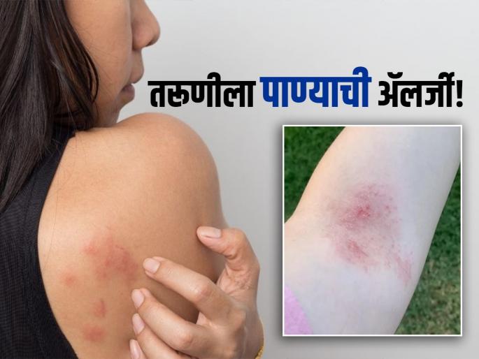 Girl with water allergy aquagenic urticaria rare disease | अजबच! 'या' तरुणीला पाण्यासह ४० गोष्टींची ॲलर्जी, पाण्याची ॲलर्जी असेल तर जगते कशी..