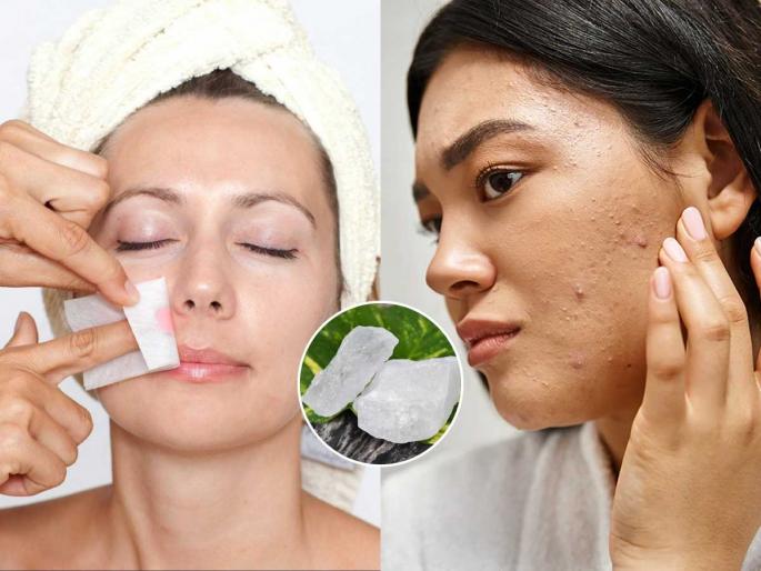 How to prevent pimples after face waxing naturally Alum benefits for face acne and open pores How to use fitkari after upper lip threading | थ्रेडिंग-वॅक्सिंग केल्यानंतर चेहऱ्यावर दाणे- लाल चट्टे येतात? 'हा' पांढरा पदार्थ करेल जादू, पिंपल्स-ओपन पोर्स, जळजळ होईल कमी How to prevent pimples after face waxing naturally Alum benefits for face acne and open pores How to use fitkari after upper lip threading | थ्रेडिंग-वॅक्सिंग केल्यानंतर चेहऱ्यावर दाणे- लाल चट्टे येतात? 'हा' पांढरा पदार्थ करेल जादू, पिंपल्स-ओपन पोर्स, जळजळ होईल कमी