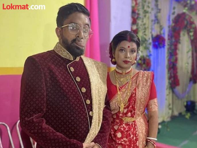 Man born with deformed face find true love Amit Ghosh and Piyali love story | विद्रूप चेहऱ्यामुळे कुणी प्रेम करणार नाही असं वाटायचं, तेव्हाच जीवनात आली सुंदर तरूणी आणि... Man born with deformed face find true love Amit Ghosh and Piyali love story | विद्रूप चेहऱ्यामुळे कुणी प्रेम करणार नाही असं वाटायचं, तेव्हाच जीवनात आली सुंदर तरूणी आणि...