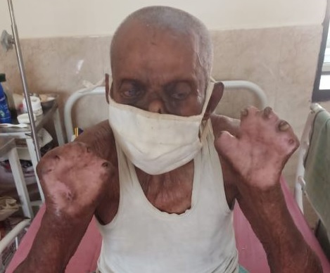 Coronavirus positive story; The 80-year-old Rajappa from Anandvan defeated Corona twice | Coronavirus positive story; आनंदवनातील ८० वर्षीय राजप्पांची दोनदा कोरोनावर मात Coronavirus positive story; The 80-year-old Rajappa from Anandvan defeated Corona twice | Coronavirus positive story; आनंदवनातील ८० वर्षीय राजप्पांची दोनदा कोरोनावर मात