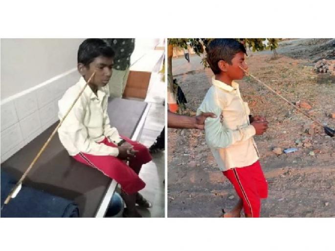 An arrow pierced the cheek of a 15 YO boy during archery training in amravati | धनुर्विद्या प्रशिक्षणादरम्यान मुलाच्या चेहऱ्यात घुसला बाण अन्...; अमरावतीतील घटना An arrow pierced the cheek of a 15 YO boy during archery training in amravati | धनुर्विद्या प्रशिक्षणादरम्यान मुलाच्या चेहऱ्यात घुसला बाण अन्...; अमरावतीतील घटना