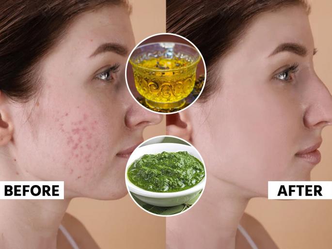 Ayurvedic Remedy For Pimple Nutritionist Shweta Shah Shares 7 Day Pimple Remedy That Cool Your Pitta & Clear Your Skin Home Remedies for Pimples How to remove a pimple according to Ayurveda | पित्तदोष वाढून त्वचेवर पिंपल्स येतात? दोन्ही समस्यांवर १ असरदार उपाय - पित्त होईल कमी पिंपल्स गायब...