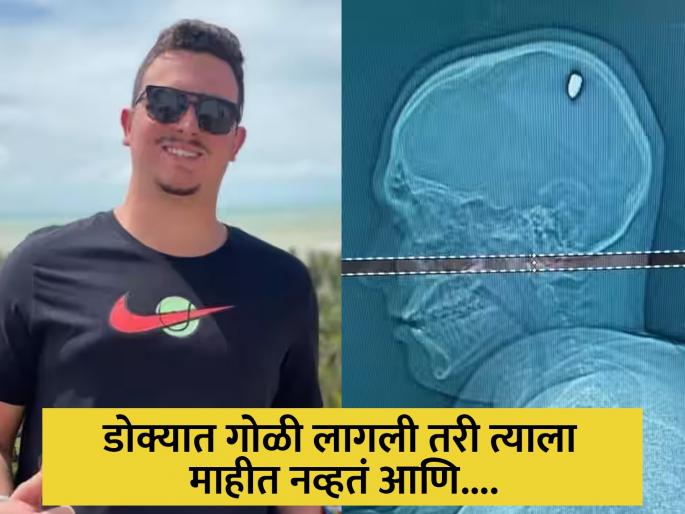 man parties for four days even after getting bullet shot in the head | डोक्यात गोळी लागली तरी त्याला नव्हती कल्पना, रक्त पुसून पुन्हा पार्टीत होता गुंग! man parties for four days even after getting bullet shot in the head | डोक्यात गोळी लागली तरी त्याला नव्हती कल्पना, रक्त पुसून पुन्हा पार्टीत होता गुंग!