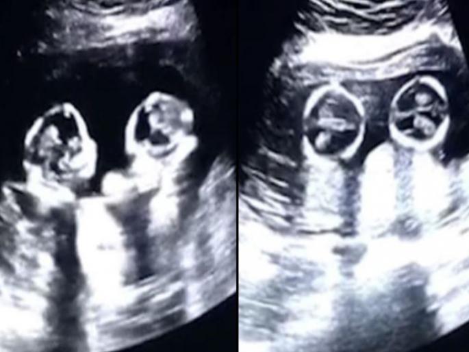 Twins spotted fighting inside mother womb during ultrasound | आईच्या पोटातच जुळ्या अर्भकांची भांडणं; व्हायरल झाला VIDEO Twins spotted fighting inside mother womb during ultrasound | आईच्या पोटातच जुळ्या अर्भकांची भांडणं; व्हायरल झाला VIDEO