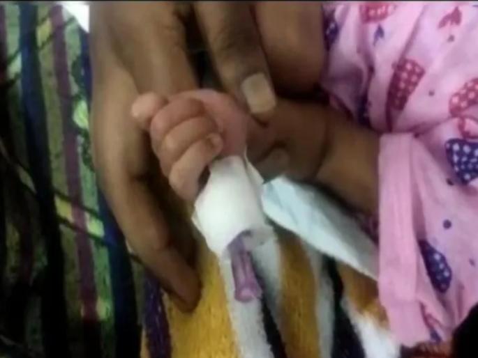 Shocking! The nurse cut off the baby's finger while talking on the phone while trying to cut the bandage | धक्कादायक! कापायची होती पट्टी, फोनवर बोलण्याच्या नादात नर्सने कापले बाळाचे बोट Shocking! The nurse cut off the baby's finger while talking on the phone while trying to cut the bandage | धक्कादायक! कापायची होती पट्टी, फोनवर बोलण्याच्या नादात नर्सने कापले बाळाचे बोट