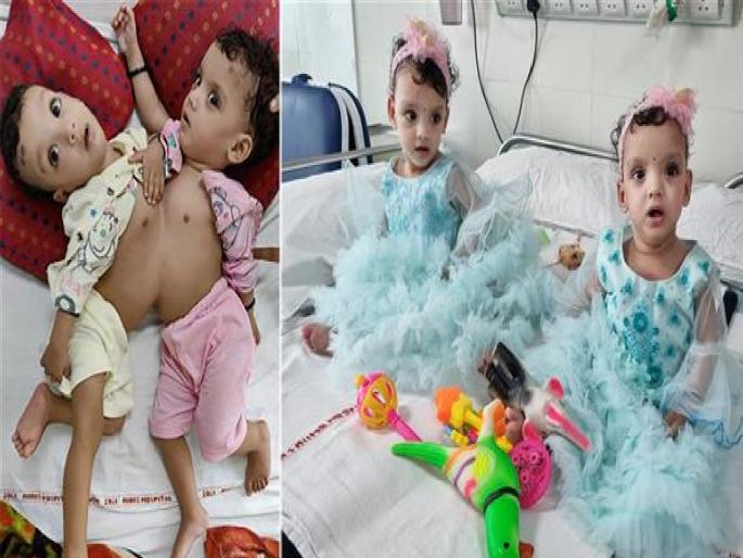 delhi-aiims-two-sisters-were-separated-after-a-long-surgery | दिल्ली AIIMS च्या डॉक्टरांचा चमत्कार; ऑपरेशननंतर जुळ्या बहिणींना दिले नवीन आयुष्य delhi-aiims-two-sisters-were-separated-after-a-long-surgery | दिल्ली AIIMS च्या डॉक्टरांचा चमत्कार; ऑपरेशननंतर जुळ्या बहिणींना दिले नवीन आयुष्य