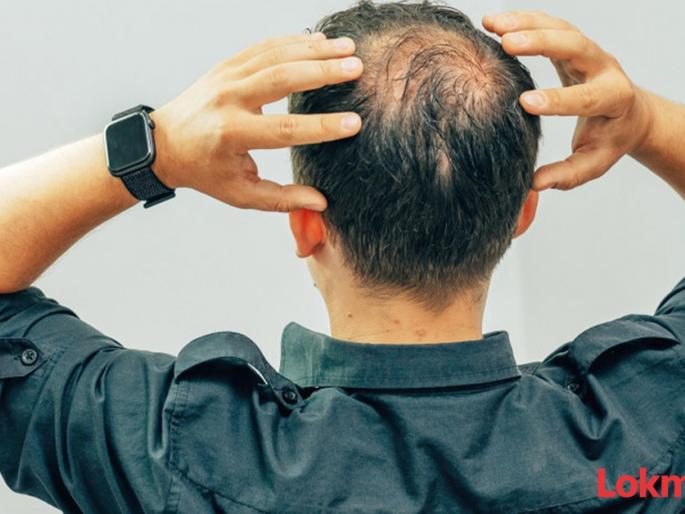 Punjab Hundreds of patients get eye infection due to treatment for baldness in Sangrur | केसगळती थांबवण्याच्या नादात अडकले; औषध लावल्यानंतर ६७ लोकांसोबत धक्कादायक प्रकार Punjab Hundreds of patients get eye infection due to treatment for baldness in Sangrur | केसगळती थांबवण्याच्या नादात अडकले; औषध लावल्यानंतर ६७ लोकांसोबत धक्कादायक प्रकार