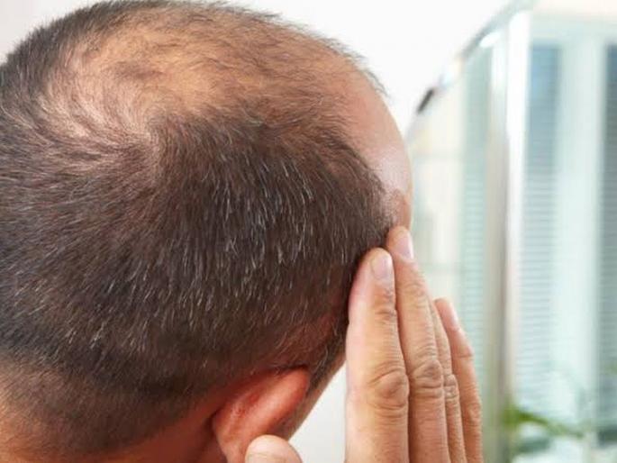 Fear of baldness, villagers say no to baldness | टक्कलची भीती, गावकरी म्हणतात अंघाेळच नको Fear of baldness, villagers say no to baldness | टक्कलची भीती, गावकरी म्हणतात अंघाेळच नको