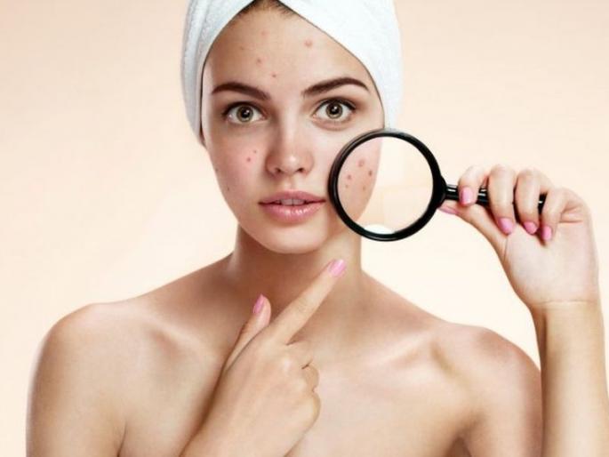 How to remove blackheads for glowing skin try these home remedies | चेहऱ्याची चमक कमी झालीये? ब्लॅकहेड्सने हैराण आहात? करा हे उपाय How to remove blackheads for glowing skin try these home remedies | चेहऱ्याची चमक कमी झालीये? ब्लॅकहेड्सने हैराण आहात? करा हे उपाय