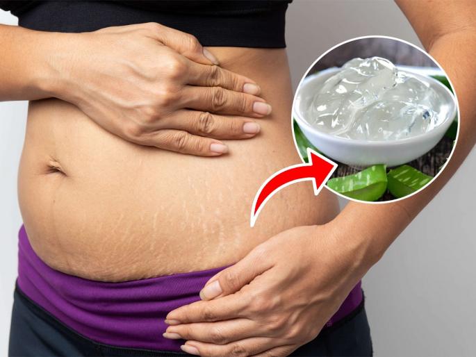 Skincare tips, 3 remedies to reduce stretch marks on thighs, buttocks and stomach, skin is stretched due to 'these' reasons | मांड्या-दंड-पोटावरचे स्ट्रेच मार्क कमी करणारे ३ उपाय, ‘या’ कारणांनी ताणली जातेय त्वचा