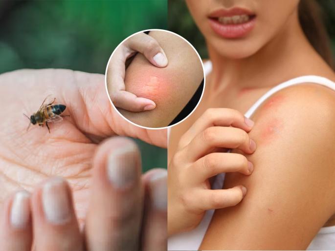 Bee Sting Home Remedies Home remedies for bee stings home remedies and natural treatments for bee stings | मधमाशी चावली तर चटकन करा ३ उपाय, विष पसरणार नाही-टळेल जीवाचाही धोका...