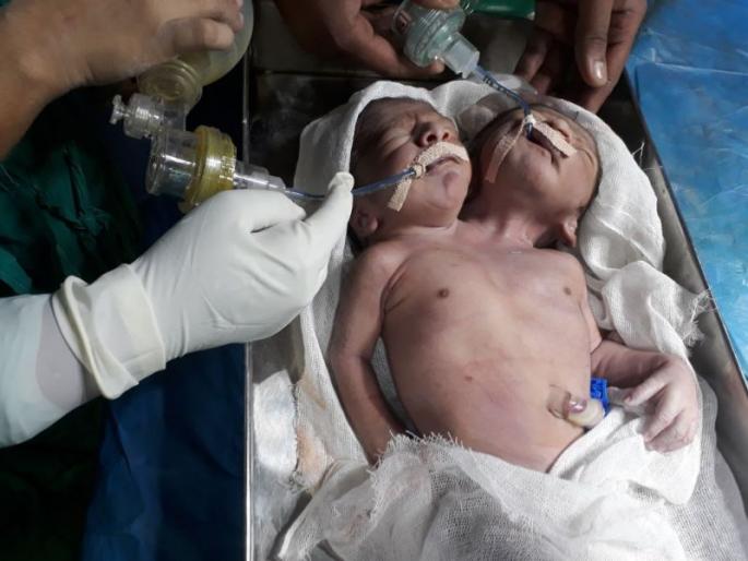 two headed baby born in beed | बीड : अंबाजोगाई वैद्यकीय महाविद्यालयाच्या प्रसूतीगृहात दोन तोंडाच्या बाळाचा जन्म, डॉ. संजय बनसोडेंनी केली यशस्वी शस्त्रक्रिया two headed baby born in beed | बीड : अंबाजोगाई वैद्यकीय महाविद्यालयाच्या प्रसूतीगृहात दोन तोंडाच्या बाळाचा जन्म, डॉ. संजय बनसोडेंनी केली यशस्वी शस्त्रक्रिया