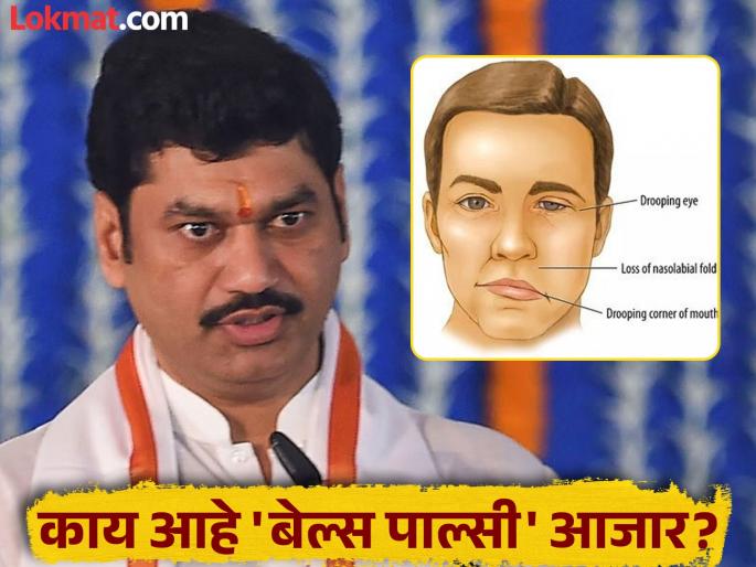 Dhananjay Munde diagnosed with Bell's Palsy, know what this disease is and its symptoms! | धनंजय मुंडे यांना बेल्स पाल्सीचं निदान, जाणून घ्या काय आहे हा आजार आणि याची लक्षणं! Dhananjay Munde diagnosed with Bell's Palsy, know what this disease is and its symptoms! | धनंजय मुंडे यांना बेल्स पाल्सीचं निदान, जाणून घ्या काय आहे हा आजार आणि याची लक्षणं!