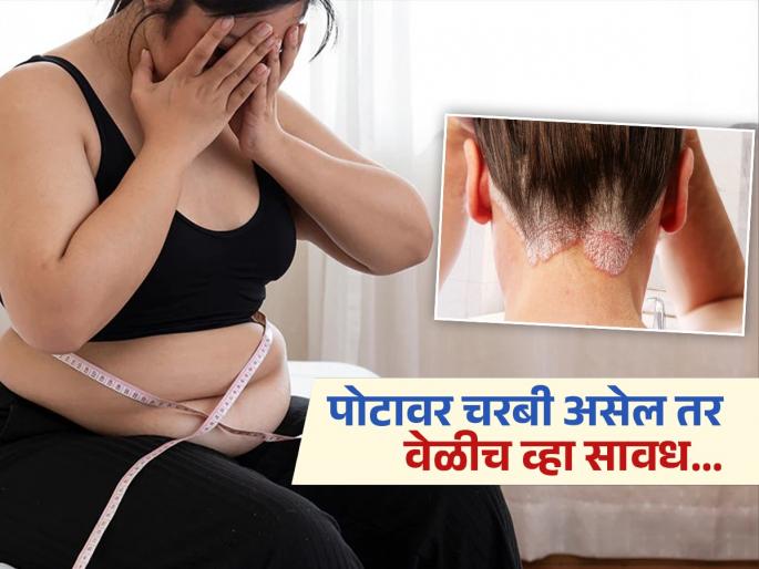 New study links belly fat to increased psoriasis risk | पोटावरील चरबीमुळे वाढतो 'या' गंभीर आजाराचा धोका, महिलांना अधिक धोक्याचा खुलासा