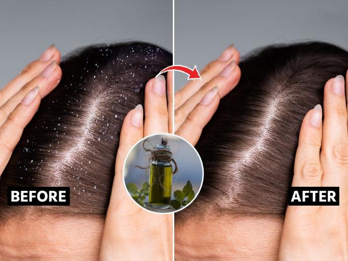 brahmi hair oil for dandruff benefits of brahmi oil for dandruff how to use brahmi oil for dandruff brahmi oil for dry scalp and dandruff | केसांतील डँड्रफ आणि खाज होईल गायब! ब्राह्मी तेलाचा असरदार उपाय - केस होतील लांबसडक, चमकदार... brahmi hair oil for dandruff benefits of brahmi oil for dandruff how to use brahmi oil for dandruff brahmi oil for dry scalp and dandruff | केसांतील डँड्रफ आणि खाज होईल गायब! ब्राह्मी तेलाचा असरदार उपाय - केस होतील लांबसडक, चमकदार...