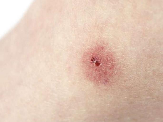 Just took a sip of his mother-in-law's cheek in pune | पुण्यात जावायानेच घेतला सासऱ्याच्या गालाचा चावा