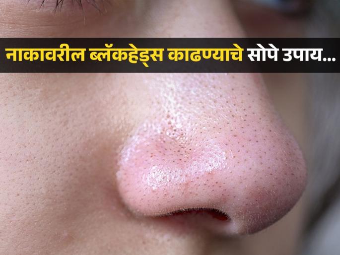 Doctor recommended 4 home remedies to get rid of blackheads | नाक, कपाळावर असलेले हट्टी ब्लॅकहेड्स सौंदर्य बिघडवतात? पाहा डॉक्टरांनी सांगितले काही उपाय