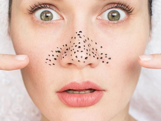 Home remedies to get rid of blackheads and whiteheads | ब्लॅकहेड्स असो किंवा व्हाइटहेड्स; 1 मिनिटात होतील दूर, करा 'हा' उपाय Home remedies to get rid of blackheads and whiteheads | ब्लॅकहेड्स असो किंवा व्हाइटहेड्स; 1 मिनिटात होतील दूर, करा 'हा' उपाय