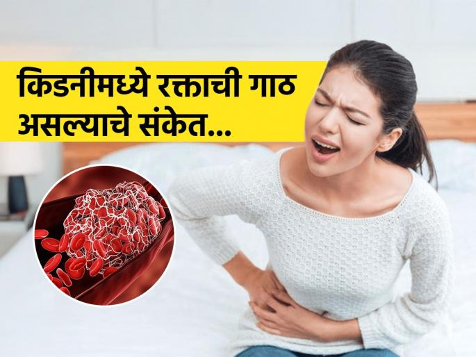 Symptoms of blood clotting in kidney, know causes and how to prevent it | किडनीत रक्ताची गाठ झाल्यावर मिळतात 'हे' संकेत, वाचा कारणं, लक्षणं आणि उपाय...रहा निरोगी
