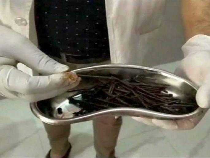 Eaten nails-nuts-bolts to quit alcohol addiction, doctor shocked to see X-rays | दारुचे व्यसन सोडण्यासाठी खाल्ले खिळे आणि नटबोल्ट, एक्स-रे पाहून डॉक्टरांना बसला धक्का