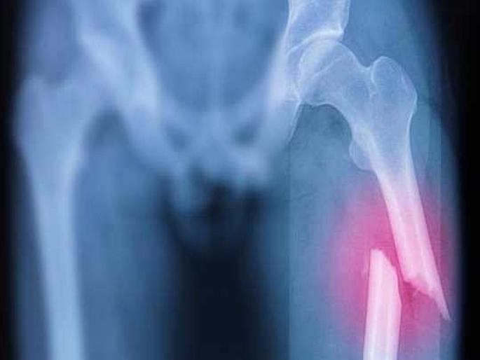 Vitamin K2 collagen and bone health | 'हे' आहे हाडांमध्ये फ्रॅक्चर येण्याचं मुख्य कारण, जगभरात याने होतात ९ मिलियन फ्रॅक्चर्स! Vitamin K2 collagen and bone health | 'हे' आहे हाडांमध्ये फ्रॅक्चर येण्याचं मुख्य कारण, जगभरात याने होतात ९ मिलियन फ्रॅक्चर्स!