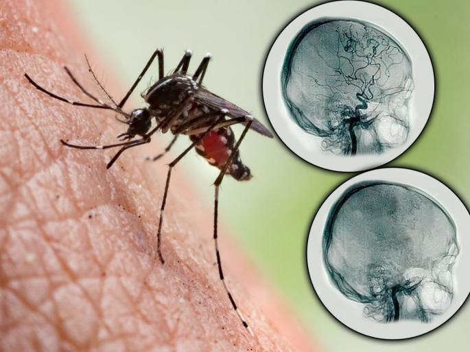 EEE mosquito borne virus cases michigan man brain dead 9 days | डासांमुळे उद्भवणारा 'हा' व्हायरस 9 दिवसांत करू शकतो 'ब्रेन डेड'; वेळीच सावध व्हा EEE mosquito borne virus cases michigan man brain dead 9 days | डासांमुळे उद्भवणारा 'हा' व्हायरस 9 दिवसांत करू शकतो 'ब्रेन डेड'; वेळीच सावध व्हा