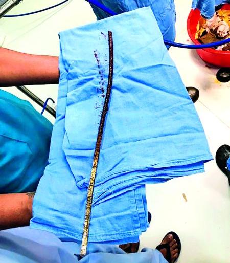 The brain has penetrated and rod took out : the laborer returned from the door of death | मेंदू छेदून शिरलेली सळाख काढली बाहेर : मृत्यूच्या दारातून परतला मजूर
