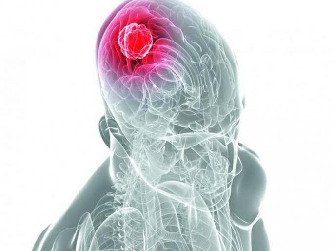 Tuberculosis in the brain, Learn Symptoms and Causes! | मेंदूलाही होतो टीबी, जाणून घ्या लक्षणे आणि कारणे!