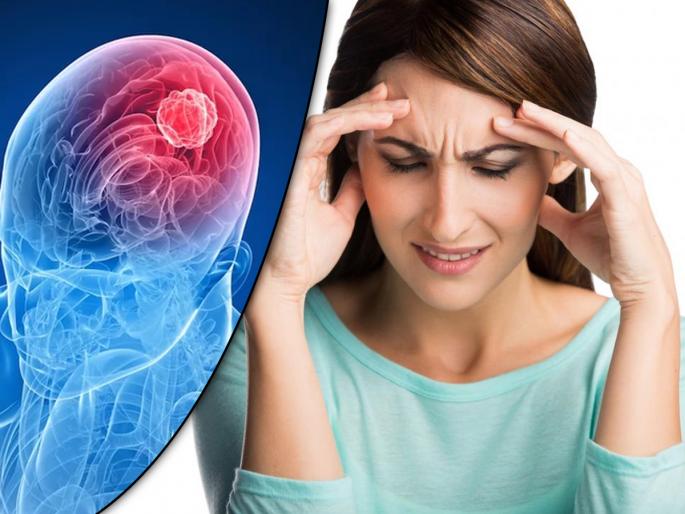 The risk of brain tumors is higher in women Know the symptoms | सावधान! ‘ब्रेन ट्यूमर’चा धोका महिलांना जास्त, ७१ टक्के ट्यूमर सौम्य; जाणून घ्या, लक्षणं The risk of brain tumors is higher in women Know the symptoms | सावधान! ‘ब्रेन ट्यूमर’चा धोका महिलांना जास्त, ७१ टक्के ट्यूमर सौम्य; जाणून घ्या, लक्षणं