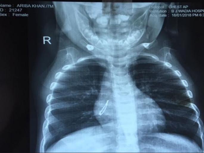 The 7-month-old baby swallowed the LED bulb, the doctor pulled out in two minutes | ७ महिन्यांच्या बाळाने गिळला एलईडी बल्ब, डॉक्टरांनी दोन मिनिटांत काढला बाहेर The 7-month-old baby swallowed the LED bulb, the doctor pulled out in two minutes | ७ महिन्यांच्या बाळाने गिळला एलईडी बल्ब, डॉक्टरांनी दोन मिनिटांत काढला बाहेर