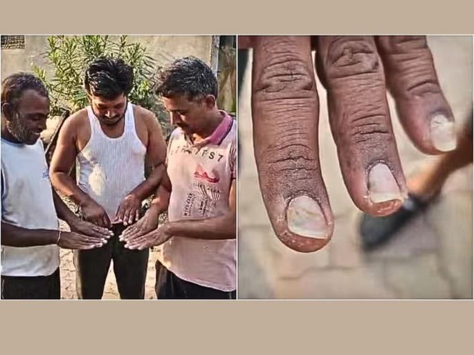 Buldhana: After hair loss, now 'nail loss'; 46 people affected; Symptoms in 5 villages in Shegaon taluka | बुलढाणा: केसगळतीनंतर आता ‘नखगळती’; ४६ जण बाधित; शेगाव तालुक्यातील ५ गावांत लक्षणे Buldhana: After hair loss, now 'nail loss'; 46 people affected; Symptoms in 5 villages in Shegaon taluka | बुलढाणा: केसगळतीनंतर आता ‘नखगळती’; ४६ जण बाधित; शेगाव तालुक्यातील ५ गावांत लक्षणे