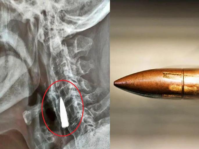bullet stuck in Ex-soldier's neck for 77 years; Even the doctor is shocked to see the X-ray... | माजी सैनिकच्या गळ्यात 77 वर्षांपासून अडकली बंदुकीची गोळी; X-ray पाहून डॉक्टरही चकीत... bullet stuck in Ex-soldier's neck for 77 years; Even the doctor is shocked to see the X-ray... | माजी सैनिकच्या गळ्यात 77 वर्षांपासून अडकली बंदुकीची गोळी; X-ray पाहून डॉक्टरही चकीत...