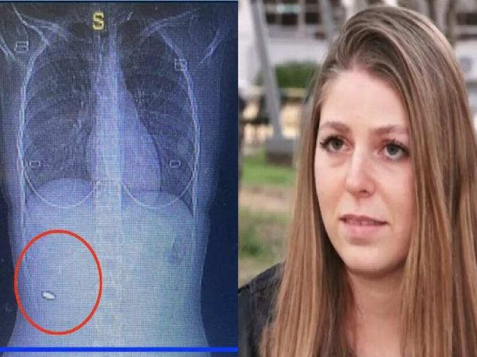 Doctors Find Bullet In Woman's Back Three Months After She Felt Pain | ऐकावं ते नवलंच! महिलेच्या शरीरात अडकली गोळी, तीन महिने समजलंच नाही; पुढे.. Doctors Find Bullet In Woman's Back Three Months After She Felt Pain | ऐकावं ते नवलंच! महिलेच्या शरीरात अडकली गोळी, तीन महिने समजलंच नाही; पुढे..