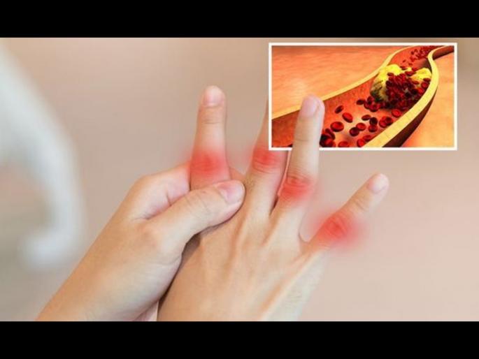 4 signs and symptoms of high cholesterol you can see in your fingers | बोटांमध्ये दिसतात कोलेस्ट्रॉल वाढल्याची ही 4 लक्षण, हार्ट अटॅकचा वाढू शकतो धोका 4 signs and symptoms of high cholesterol you can see in your fingers | बोटांमध्ये दिसतात कोलेस्ट्रॉल वाढल्याची ही 4 लक्षण, हार्ट अटॅकचा वाढू शकतो धोका