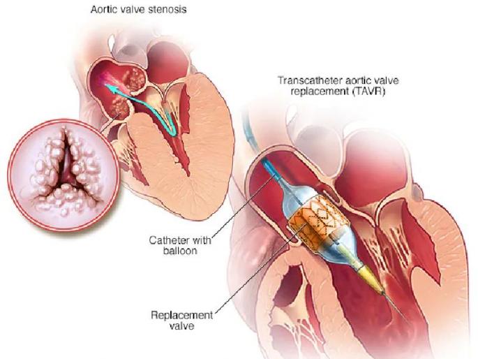 transcatheter aortic valve replacement of a 70 year old woman | विना शस्त्रक्रिया बदलली हृदयाची झडप, ७० वर्षीय रुग्णाला मिळाले जीवनदान transcatheter aortic valve replacement of a 70 year old woman | विना शस्त्रक्रिया बदलली हृदयाची झडप, ७० वर्षीय रुग्णाला मिळाले जीवनदान