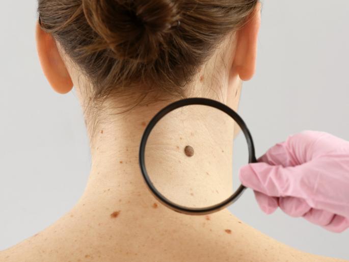 what is connection between mole and body is it a cancer symptom | त्वचेवरील तीळाचा अन् कॅन्सरचा काय संबंध? तज्ज्ञांनी दिलं उत्तर, सत्य जाणून घेण्यासाठी वाचाच what is connection between mole and body is it a cancer symptom | त्वचेवरील तीळाचा अन् कॅन्सरचा काय संबंध? तज्ज्ञांनी दिलं उत्तर, सत्य जाणून घेण्यासाठी वाचाच