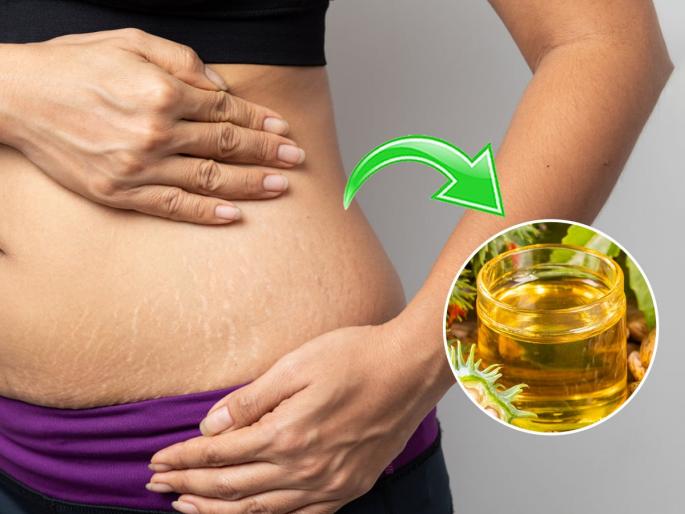 home remedy for stretch marks castor oil for stretch marks Ayurvedic treatment for stretch marks Natural way to reduce stretch marks | गरोदरपणानंतर पोटावर-दंडावर मोठ्ठे स्ट्रेच मार्क आले? ‘हे’ पारंपरिक तेल लावा-स्ट्रेच मार्क होतील कमी...
