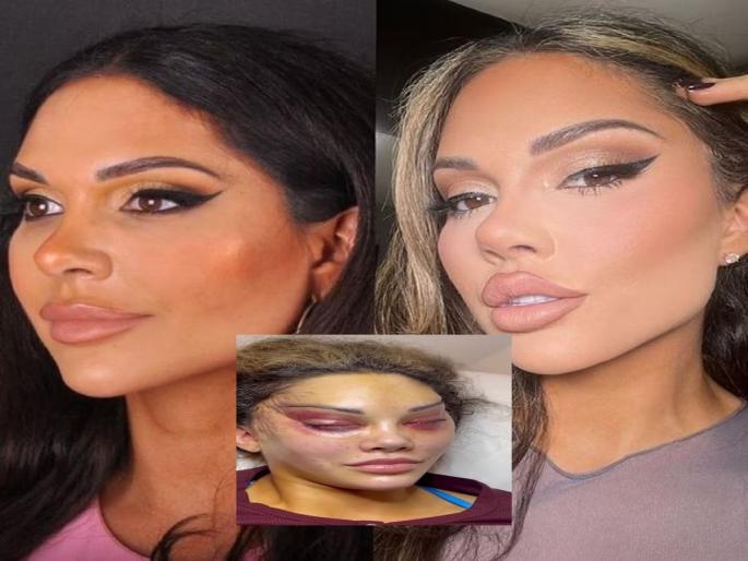 woman deforms face to get cat eyes shares pictures after procedure | अरेरे! महिलेला हवे होते मांजरीसारखे डोळे; सर्जरीनंतर चेहऱ्याची झाली भयंकर अवस्था, आता म्हणते... woman deforms face to get cat eyes shares pictures after procedure | अरेरे! महिलेला हवे होते मांजरीसारखे डोळे; सर्जरीनंतर चेहऱ्याची झाली भयंकर अवस्था, आता म्हणते...