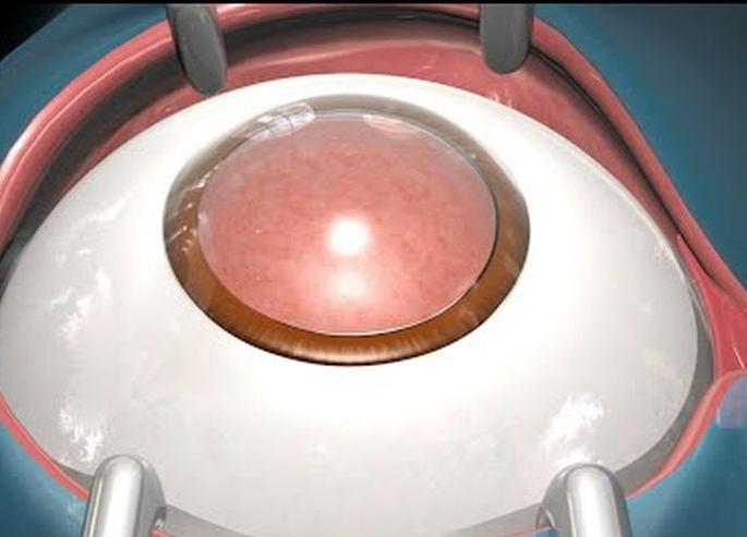 1,165 cataract surgeries in five days in the state! | पाच दिवसांत राज्यात १,१६५ मोतीबिंदू शस्रक्रिया!