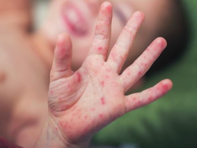 Suspected measles patients crossed 10,000 mark in maharashtra | महाराष्ट्रात गोवरच्या संशयित रुग्णांनी पार केला १० हजारांचा टप्पा Suspected measles patients crossed 10,000 mark in maharashtra | महाराष्ट्रात गोवरच्या संशयित रुग्णांनी पार केला १० हजारांचा टप्पा
