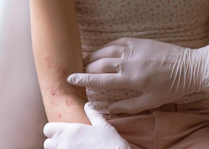 Already with fever, there is trouble with rash! | आधीच तापाची साथ त्यात पुरळचा त्रास ! डॉक्टरांचा सल्ला घ्या Already with fever, there is trouble with rash! | आधीच तापाची साथ त्यात पुरळचा त्रास ! डॉक्टरांचा सल्ला घ्या