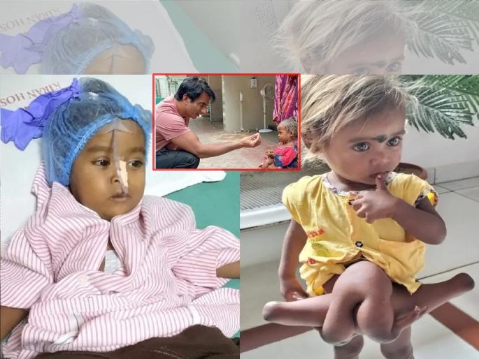 Sonu Sood: Successful Surgery on 4 Hands and 4 Foot Chimukli chahumukhi, Costed by Sonu Sood | Sonu Sood: 4 हात अन् 4 पायाच्या चिमुकलीवर यशस्वी शस्त्रक्रिया, सोनू सूदने उचलला खर्च