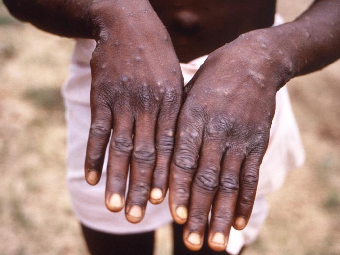 Warning: Monkey Pox has reached 15 countries | सावधान :15 देशांत पोहोचला मंकीपॉक्स, सावधगिरीच्या सूचना Warning: Monkey Pox has reached 15 countries | सावधान :15 देशांत पोहोचला मंकीपॉक्स, सावधगिरीच्या सूचना