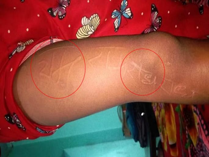 Ram appeared on the hands of Vidyarthi.. Radhe...; Even doctors could not solve the puzzle in hardoi girl sakshi | विद्यार्थिनीच्या हातावर उमटले राम... राधे...; डॉक्टरांनाही उलगडेना कोडे Ram appeared on the hands of Vidyarthi.. Radhe...; Even doctors could not solve the puzzle in hardoi girl sakshi | विद्यार्थिनीच्या हातावर उमटले राम... राधे...; डॉक्टरांनाही उलगडेना कोडे